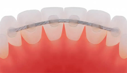 ⊛ Férula dental: ¿cuáles son sus tipos y cómo se usan?