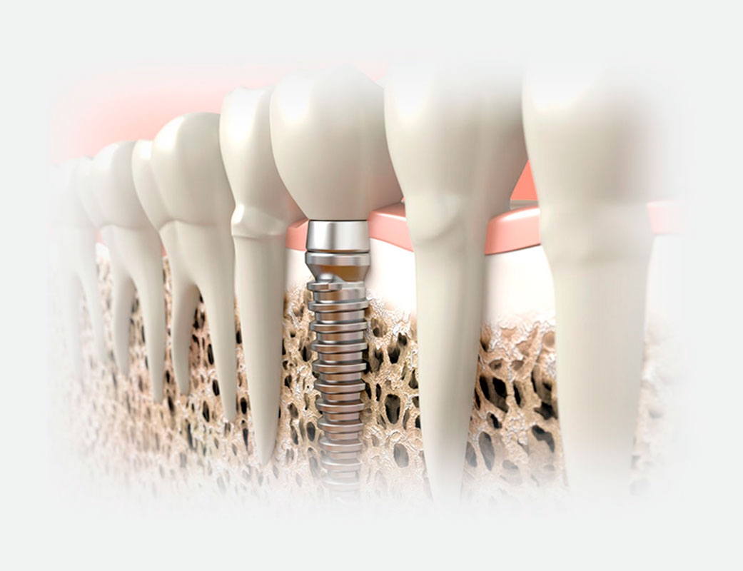implantes-dentales.jpg